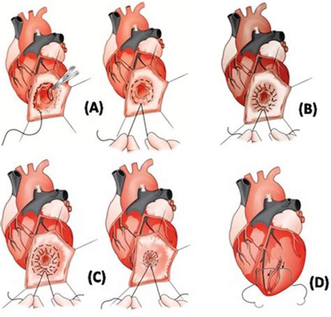 left ventricular aneurysm repair surgery.